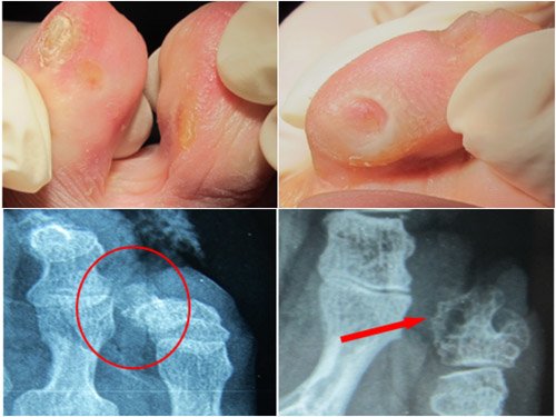 ojo de gallo en el pie - podologo malaga