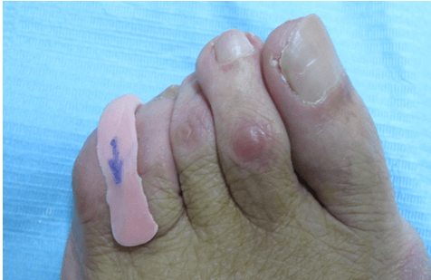 operacion ojo de gallo pies podologo malaga