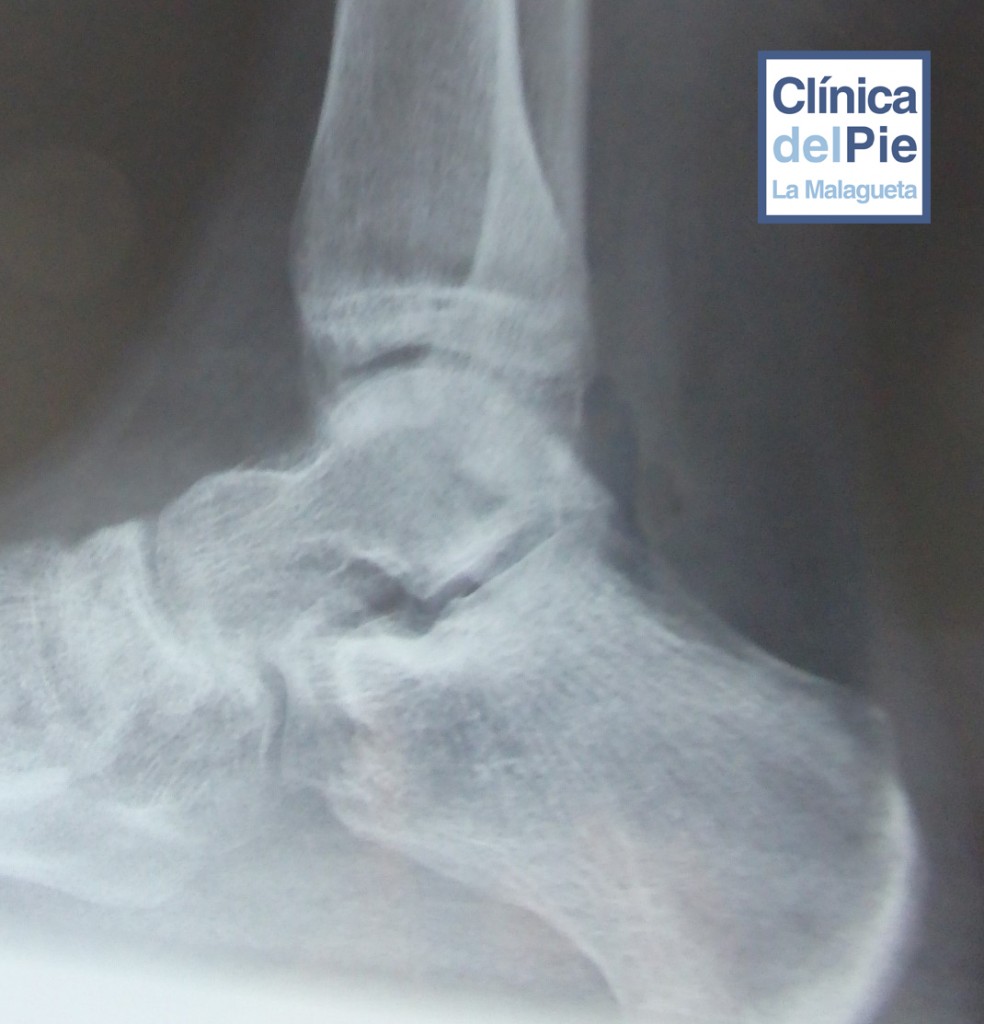 podologo malaga sindrome sucker radiografia