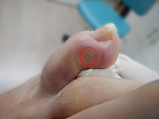 Consejo prevenir ojo de gallo podologo malaga