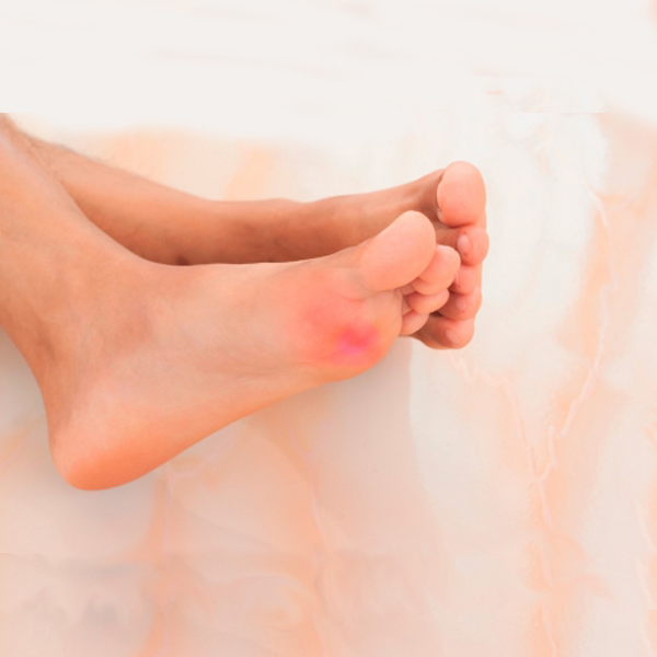 Neuroma morton tratamiento podologo malaga