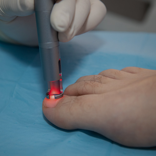 onicomicosis laser clinicadelpie