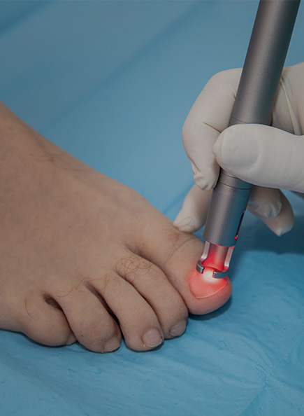 servicio tratamiento unas laser clinicadelpie